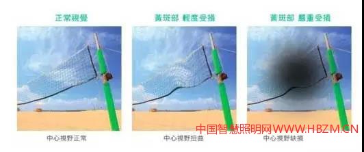 圖4黃斑部病變的視覺狀況；視覺成像功能已受影響及傷害